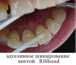 Адгезивное шинирование лентой Ribbond. Стоматология АристократЪ-Дент