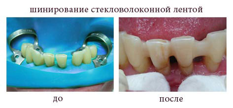 Шинирование стекловолоконной лентой. Стоматология АристократЪ-Дент Шинирование стекловолоконной лентой. Стоматология АристократЪ-Дент