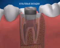 Восстановление коронковой части зуба культевой вкладкой. Стоматология АристократЪ-Дент