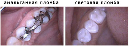 Стоматология АристократЪ-Дент. Амальгамные и световые зубные пломбы